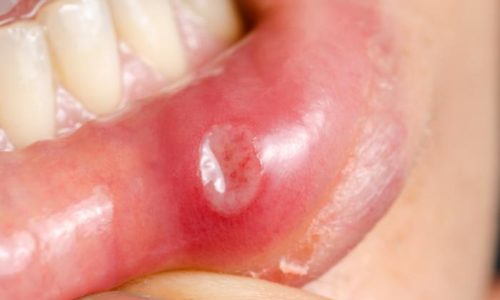 Home Remedies that help getting rid of Canker Sores