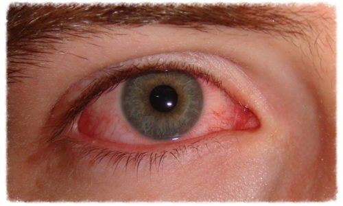 Seven Reasons Why Your Eyes are Bloodshot with Solutions