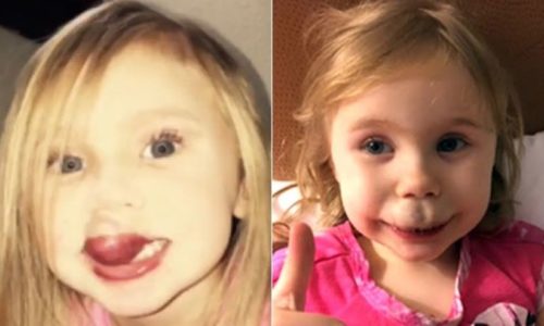 Toddler receives life changing surgery for huge facial birthmark